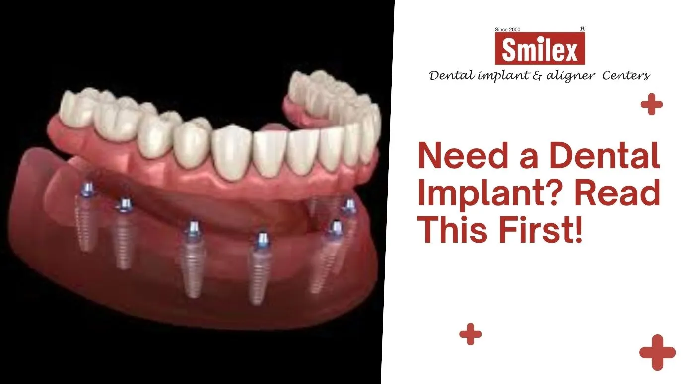 Dental Implants