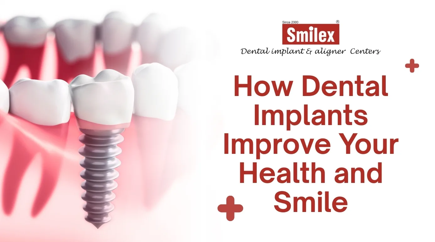 Dental Implants