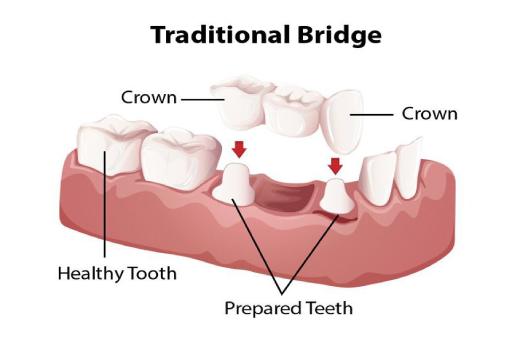types of dental bridges