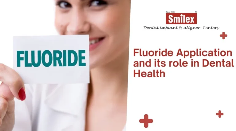 Fluoride Application