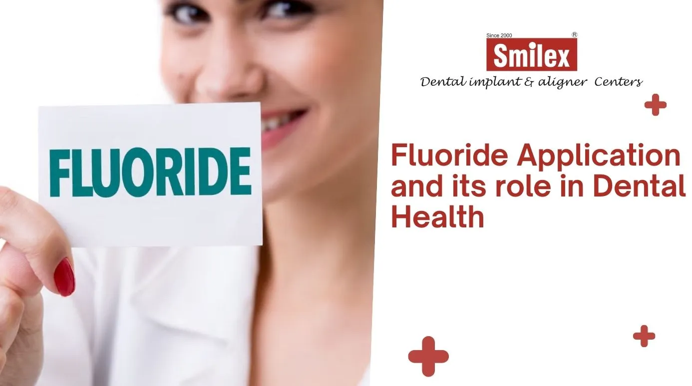 Fluoride Application