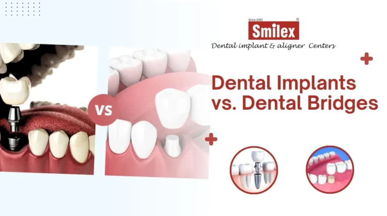 Dental Implants vs. Dental Bridges