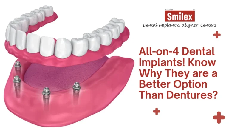 All-on-4 Dental Implants