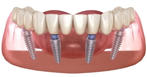 all on 4 dental implants