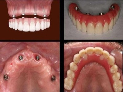before and after all on 4 dental implants