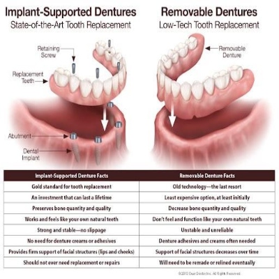 all on 4 dental implants near me