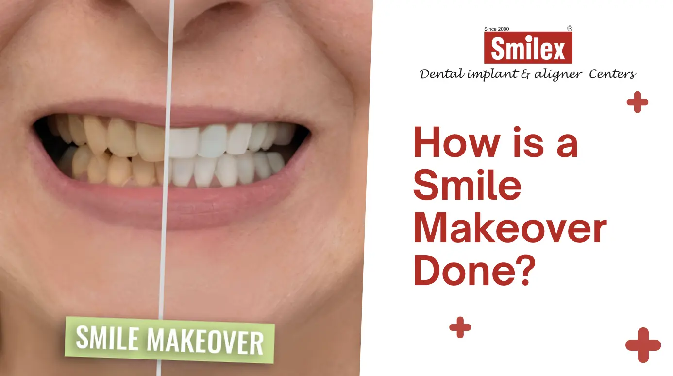 Smile Makeover