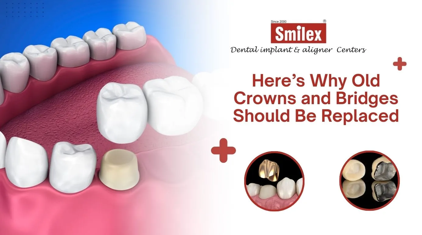 Here’s Why Old Crowns and Bridges Should Be Replaced