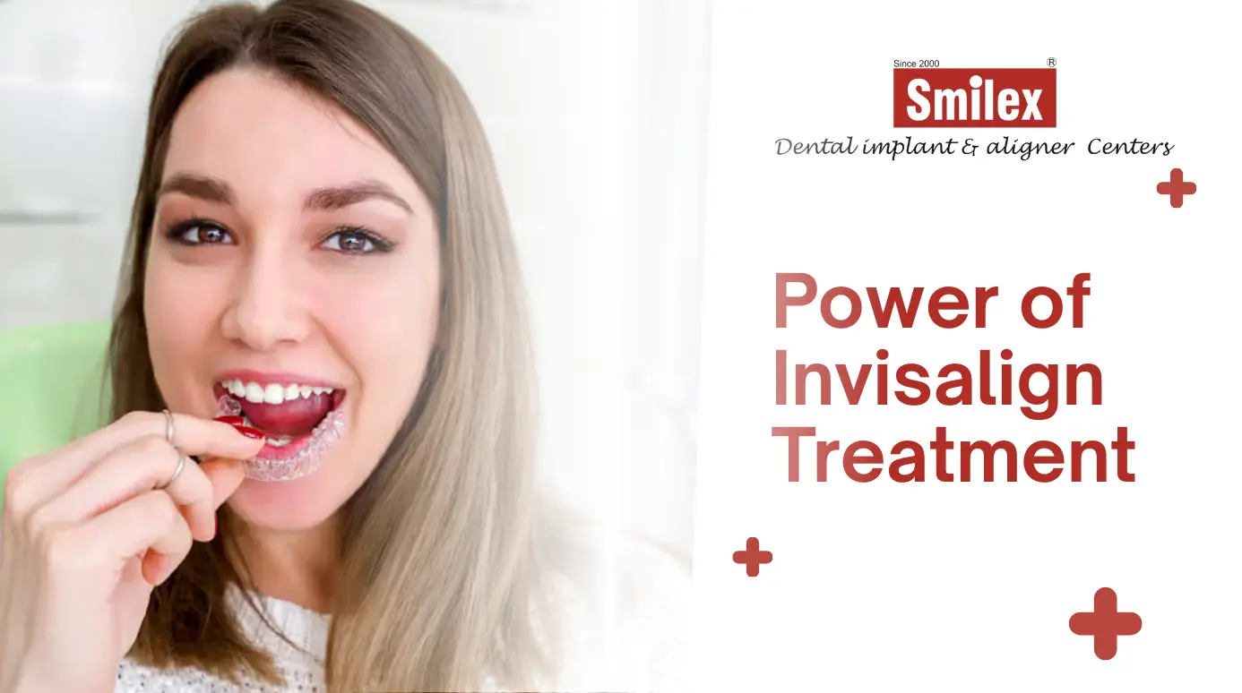 Invisalign