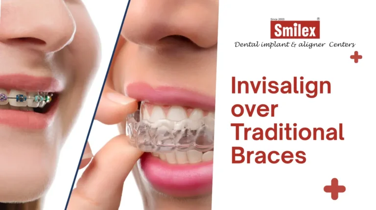 Invisalign