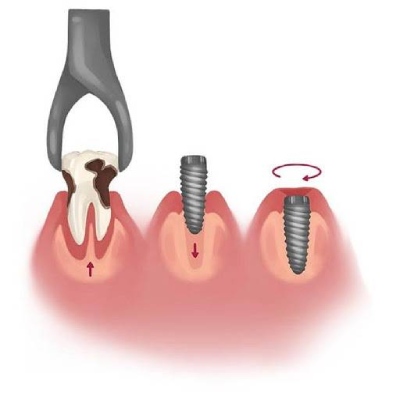 dental implants process