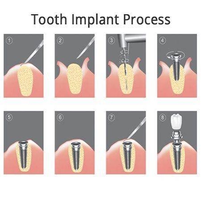 dental implants process