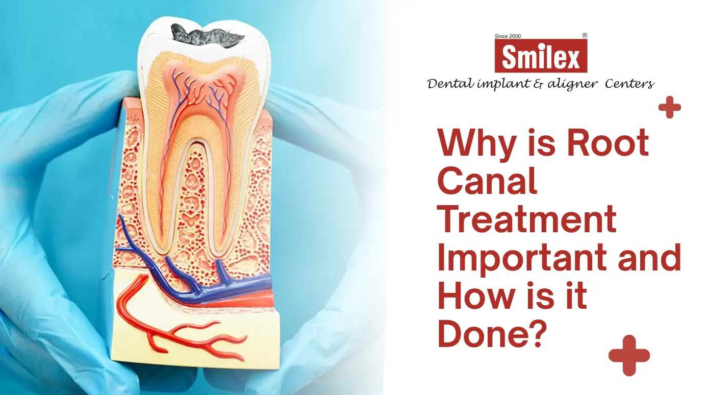 Root Canal Treatment