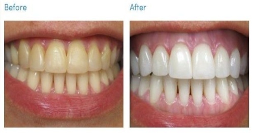 Teeth Whitening