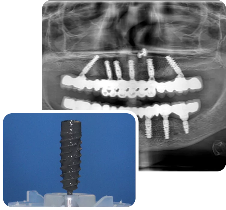 Dental Implants