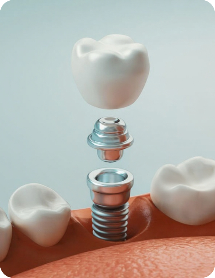Dental Implants