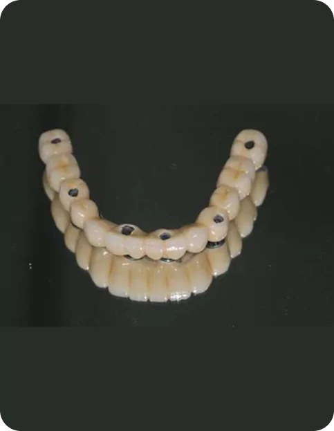 Full Mouth Implants