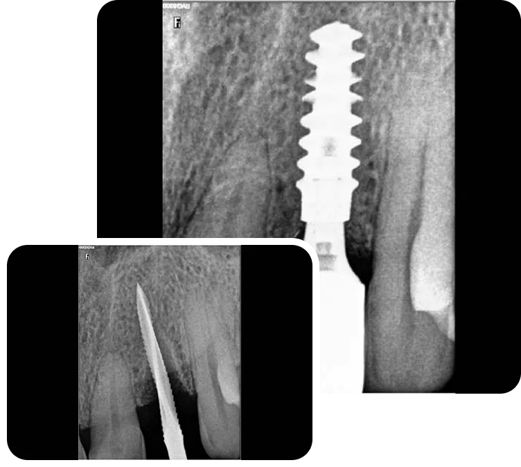 Same Day Dental Implants