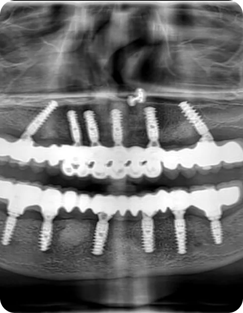 Multiple Teeth Implants