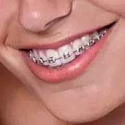 steel braces