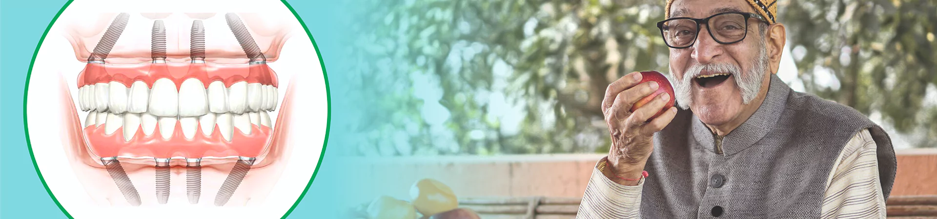 Full Mouth Dental Implants