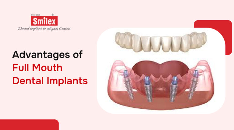 Full Mouth Dental Implants