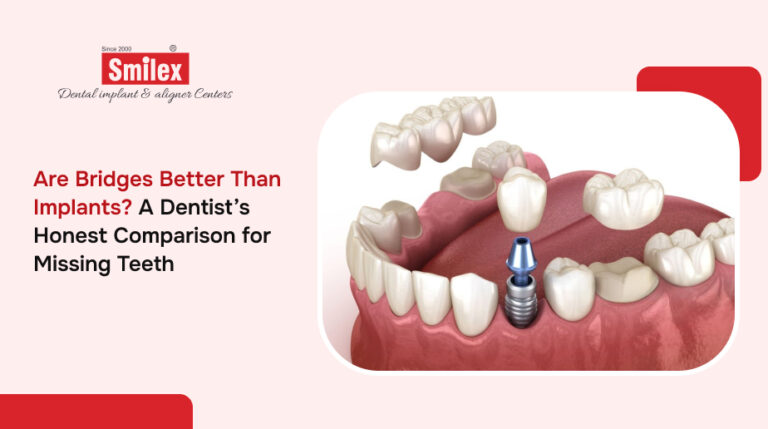Are Bridges Better Than Implants? A Dentist’s Honest Comparison for Missing Teeth