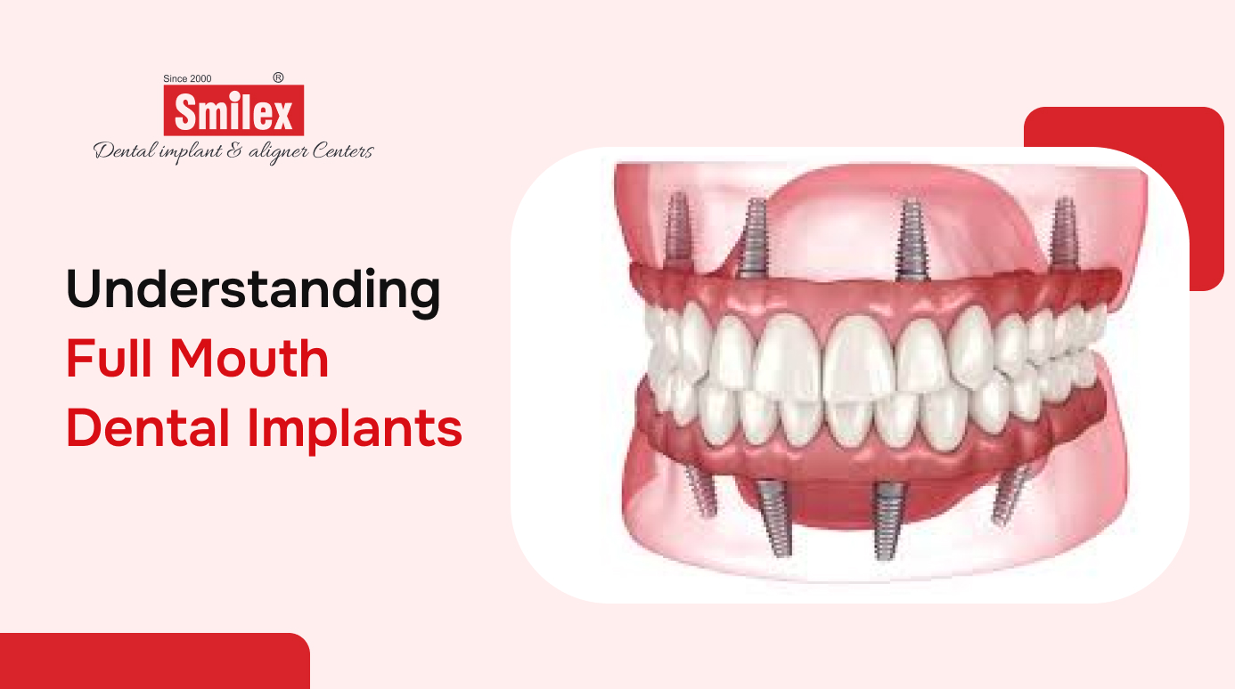 Full Mouth Dental Implants