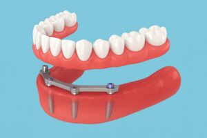 All on 4 Implants