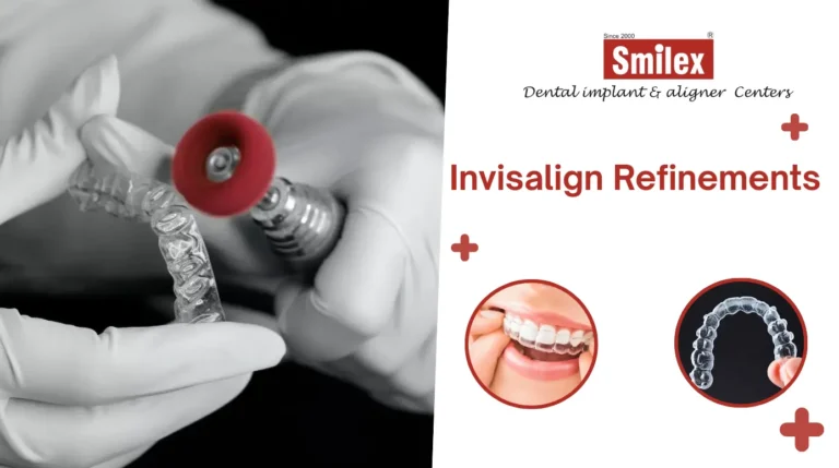 Invisalign Refinements