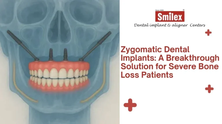 Zygomatic Dental Implants
