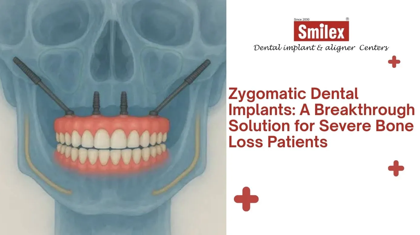 Zygomatic Dental Implants