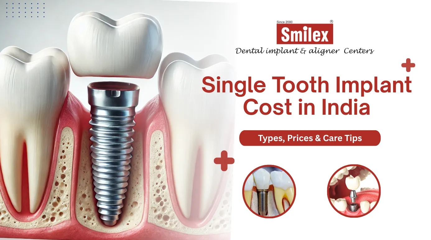 Single Tooth Implant Cost in India: Types, Prices & Care Tips