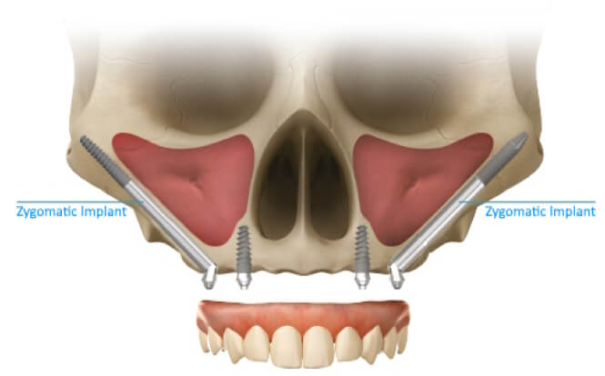 Zygomatic Implants