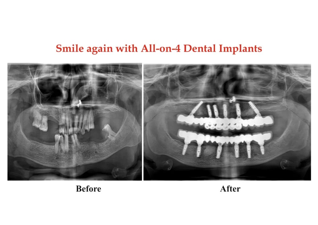 All on 4 Implants