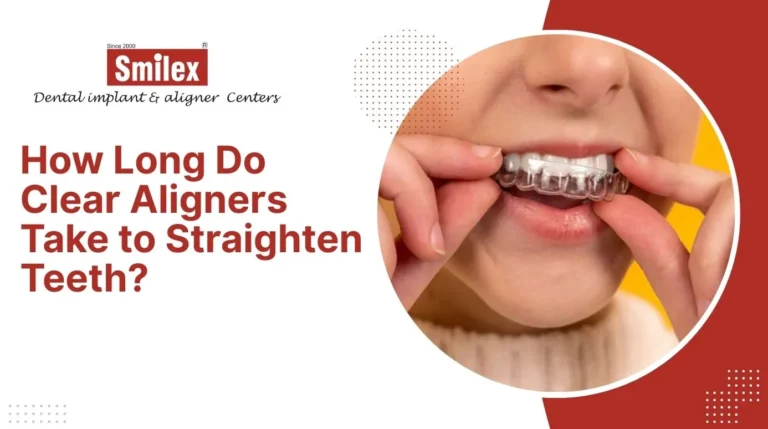 Clear Aligners